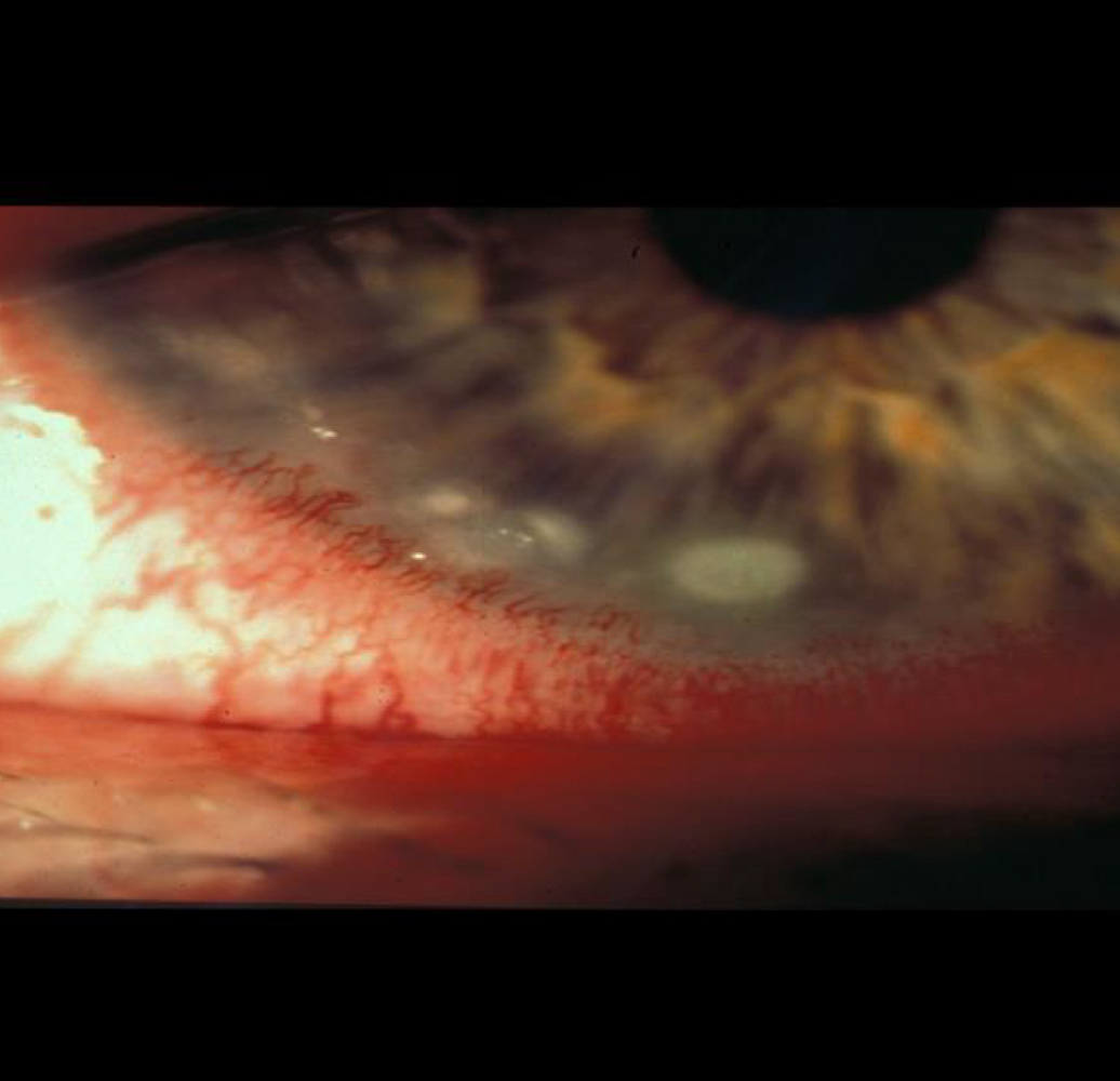 <p>What ocular anomaly is shown here?</p>