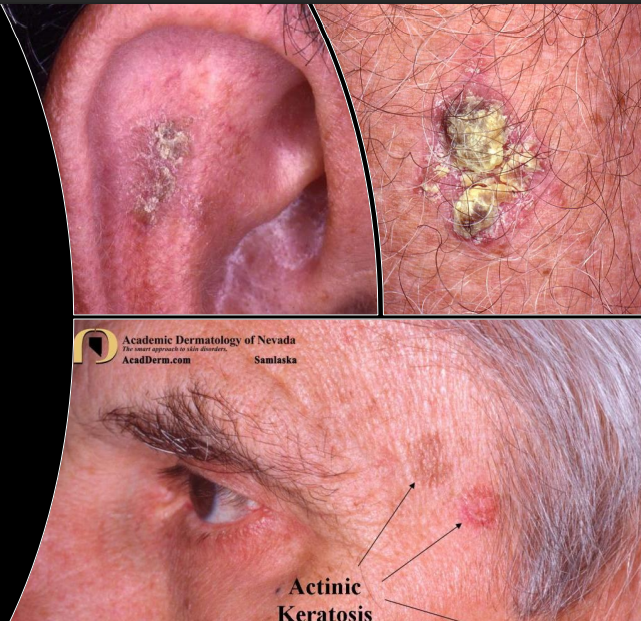 <p>rough, scaly patches on face, ears, neck, scalp, and other areas </p>