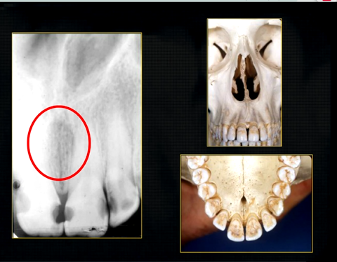 <p>what does this anterior periapical graph show?</p>