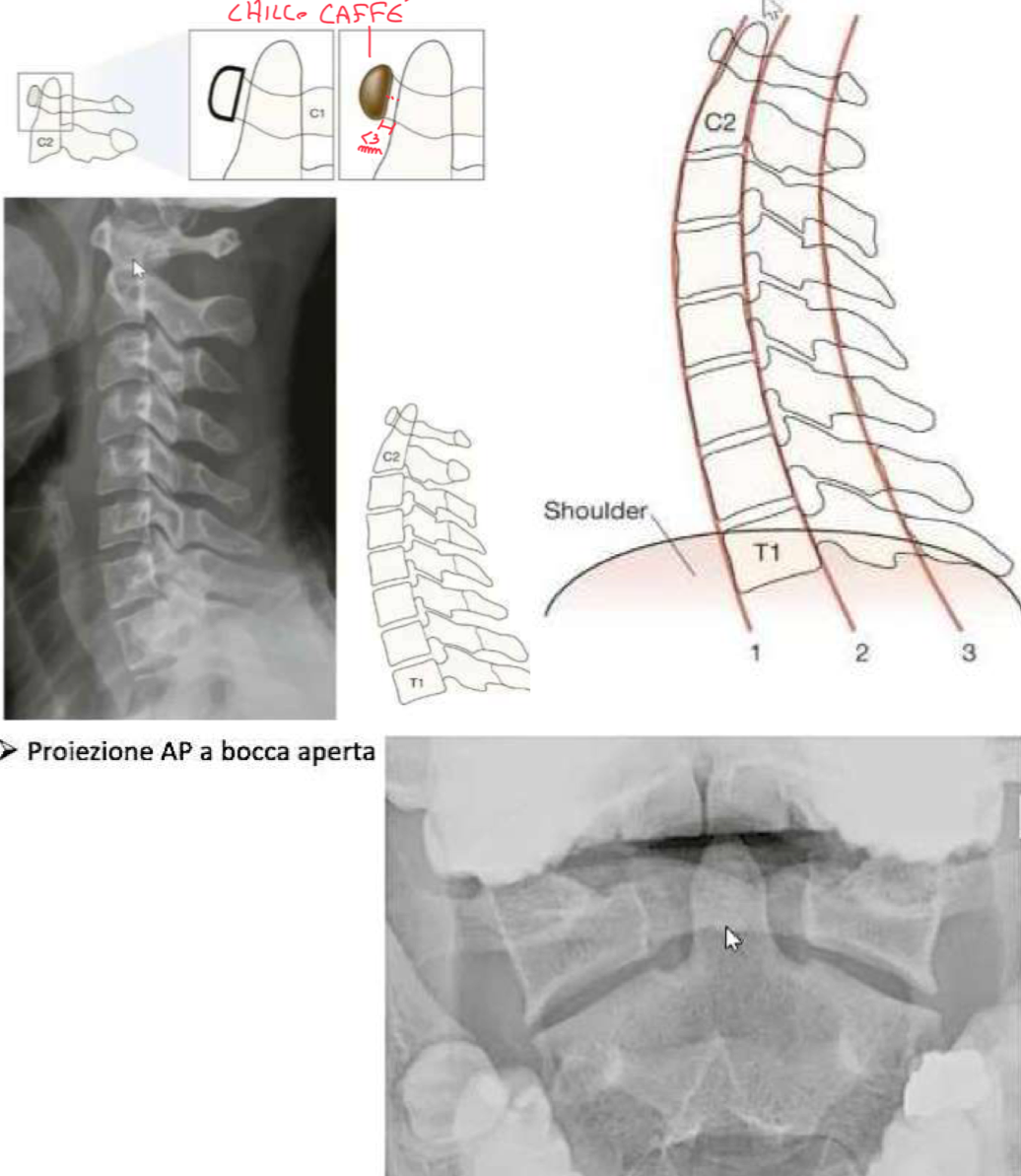 <p>Il rachide cervicale, in particolare C1 e C2, è una regione delicata dove fratture o lussazioni possono avere conseguenze gravissime.</p><p>Identificazione radiologica:</p><ul><li><p>Proiezione laterale → arco anteriore di C1 ha forma a chicco di caffé → il radiologo osserverà la distanza tra la faccia posteriore di questo chicco e la faccia anteriore del dente dell’epistrofeo → questa distanza non deve superare i 3mm → un aumento della distanza indica una possibile lussazione atlanto-assiale o lesione legamentosa (in particolare legamento trasverso) con rischio instabilità e compressione midollare.</p></li><li><p>Un’altra osservazione importante è valutare l’allineamento delle vertebre cervicali → in proiezione laterale si valutano tre linee di continuità che devono presentarsi lisce e leggermente convesse in avanti → linea anteriore dei corpi vertebrali, linea posteriore dei corpi vertebrali, linea spino-laminale corrispondente alla giunzione delle lamine dove originano il processo spinoso → interruzione o angolazione anomala o scalino può indicare frattura, sublussazione o dislocazione → in questa valutazione è importante che sia visibile anche T1, per garantire la visualizzazione dell’allineamento dell’intero tratto cervicale</p></li><li><p>I corpi vertebrali C3 a C7 appaiano quadrangolare o rettangolari</p></li><li><p>Gli spazi tra i processi spinosi devono essere uniformi e simmetrici</p></li><li><p>Proiezione Antero-posteriore a bocca aperta → per visualizzare meglio C1 e C2, dato la sovrapposizione con il viscerocranio → si valuta la simmetria tra le masse laterali di C1 e il dente di C2</p></li></ul><p></p>