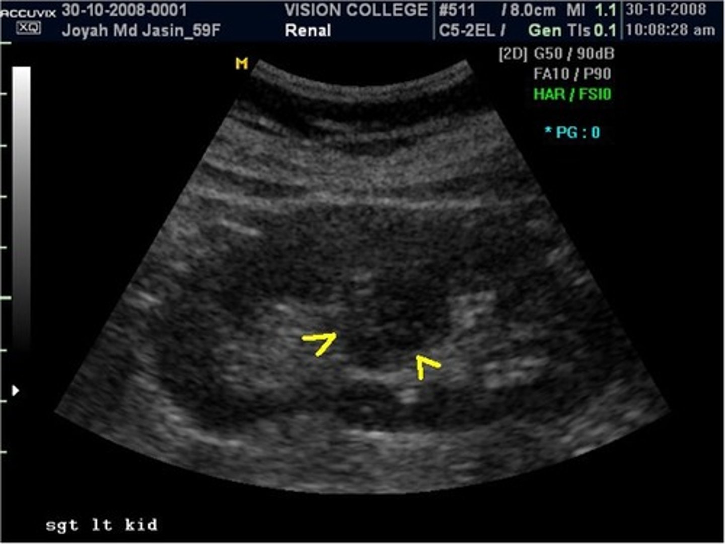 <p>RCC has a similar appearance to what normal renal variant? </p>