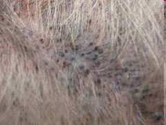 <p>Blackhead or buildup of Sebum and keratin in a pore </p>