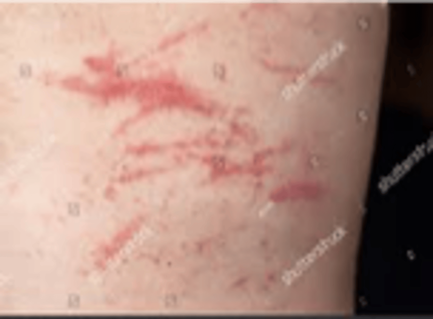 <p>An abrasion or scratch mark.</p><p>May be linear or rounded.</p>