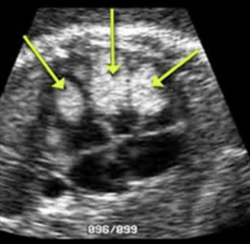 <p>what are the arrows pointing to on this 4 chamber heart view</p><p>a) hypoplastic left heart</p><p>b) multiple echogenic intracardiac foci </p><p>c) rhabdomyoma</p><p>d) pulmonary sequestration </p>