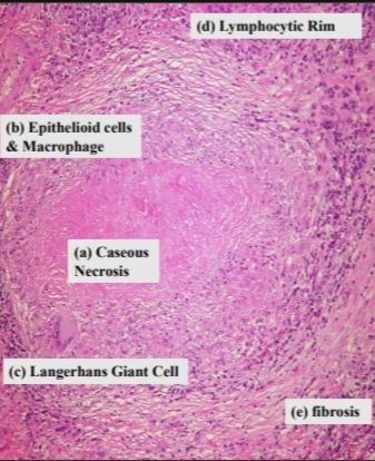 <p><strong>Tubercle</strong></p><p></p><p>1. Epithelioid cells and macrophages.</p><p>2.caseous necrosis </p><p>3.Langhan's giant cells. </p><p>4. Lymphocytes. </p><p>5.Peripheral fibroblastic reaction (fibrosis).</p>