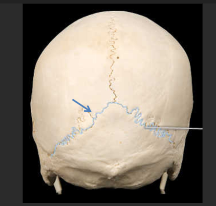 <p>What suture is this?</p>