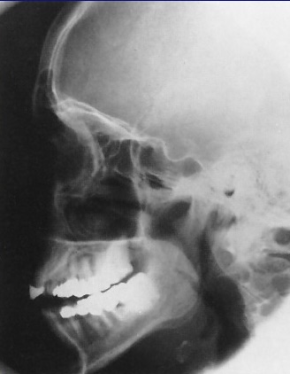 <p>What is this x-ray demonstrating?</p>