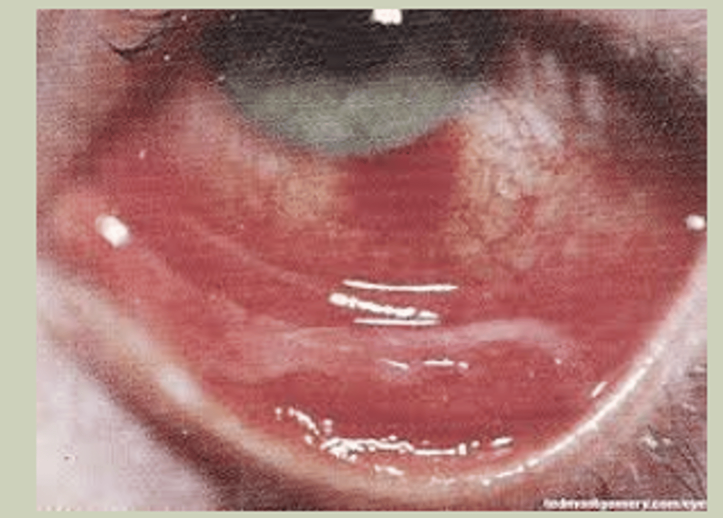 <p>-Bilateral, symmetric presentation</p><p>-More common in adults</p><p>-SX: profuse watery discharge, periorbital pain</p><p>-Signs: Bilateral red eyes with serous discharge, pre-auricular adenopathy, pseudomembranes, or subepithelial infiltrates </p><p>-TX: Refer to ECP for pseudomembrane peeling, pt education about contagiousness</p>
