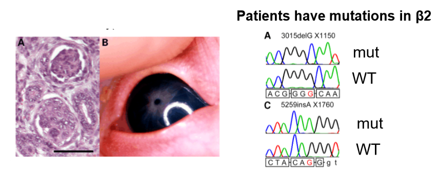 <ul><li><p>pierson syndrome- rare lethal condition </p></li><li><p>congenital nephrotic syndrome progressing to end stage renal disease</p></li><li><p>eye abnormalities</p></li><li><p>sever muscular hypotonia </p></li><li><p>laminin 11(alpha5beta2gamma1) expressed in GBM, eye and synaptic BM, explains disease phenotype </p></li><li><p>frame shift mutation</p></li><li><p>glomeruli don’t filter properly, similar to alports </p></li><li><p>affecting tissue where laminin trimer has key role </p></li></ul><p></p>
