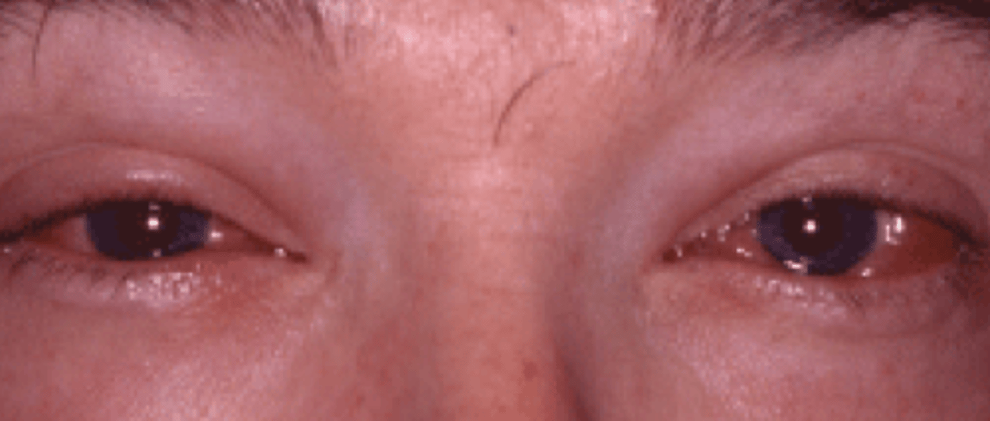 <p>What viral ocular condition can have a "mucopurlent discharge" with other symptoms such as profuse watering, chemosis, and lid edema?</p>