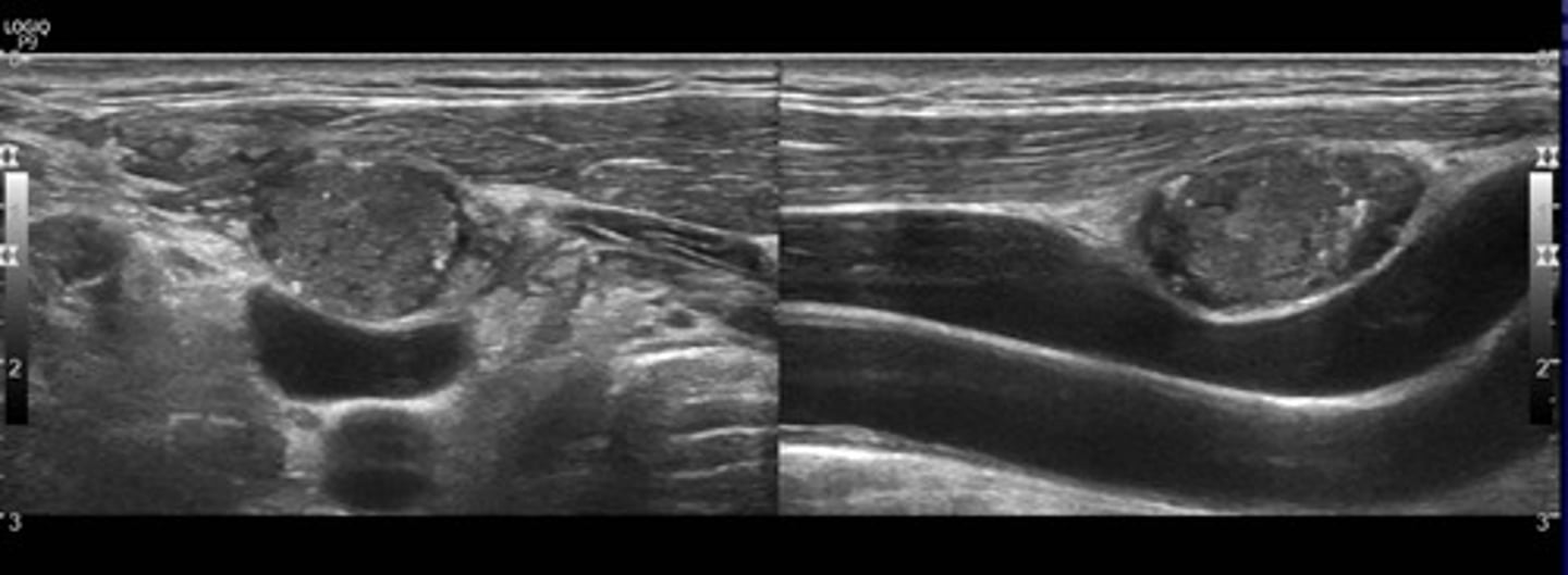 <p>Malignant cervical lymph nodes</p>