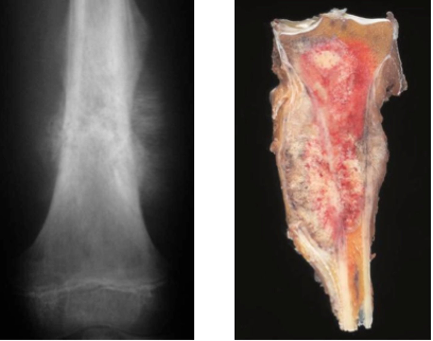 <p>malignant sarcoma of bone</p>