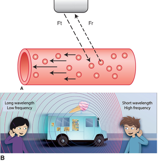 <ul><li><p><strong>A</strong>. The transmitted Doppler sound beam (Ft) encounters red blood cells (RBCs) moving toward the transducer within the blood vessel. The RBC motion causes an increase in frequency of the returning echo (Fr) due to the Doppler effect. The ultrasound instruments detect and measure the frequency of the returning Doppler signal, confirming the presence of blood flow and the direction in which the blood is traveling. <strong>B</strong>. Illustration of the Doppler effect where the frequency of sound increases when object moves toward the boy and decreases when object recedes away from the girl.</p></li></ul><p></p>