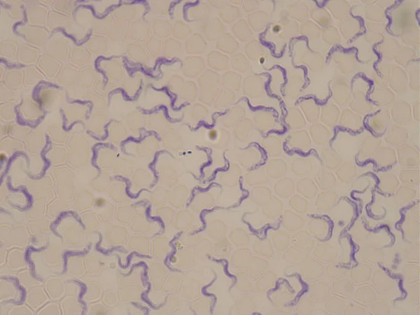 <p></p><p><strong>Spirochete, Gram stain doesn’t show well (seen by dark-field microscopy). should be colorless its consider gram neg so could be pink</strong></p><p>Type: Bacteria (spirochete = spiral-shaped); Disease: <strong>Syphilis </strong>(stages: sores → rash → hidden → damage to heart/brain);</p><p>Diagnosis: Microscopy of sores, blood tests (VDRL, RPR);</p><p>Treatment/Prevention: <strong>Penicillin </strong>G; safe sex; prenatal screening;</p><p>Spread/Unique: Human-only; sexually transmitted or through pregnancy; no vaccine.</p>