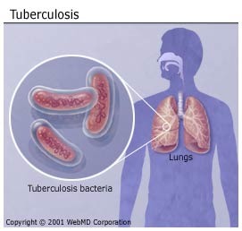 BCG (Tuberculosis)