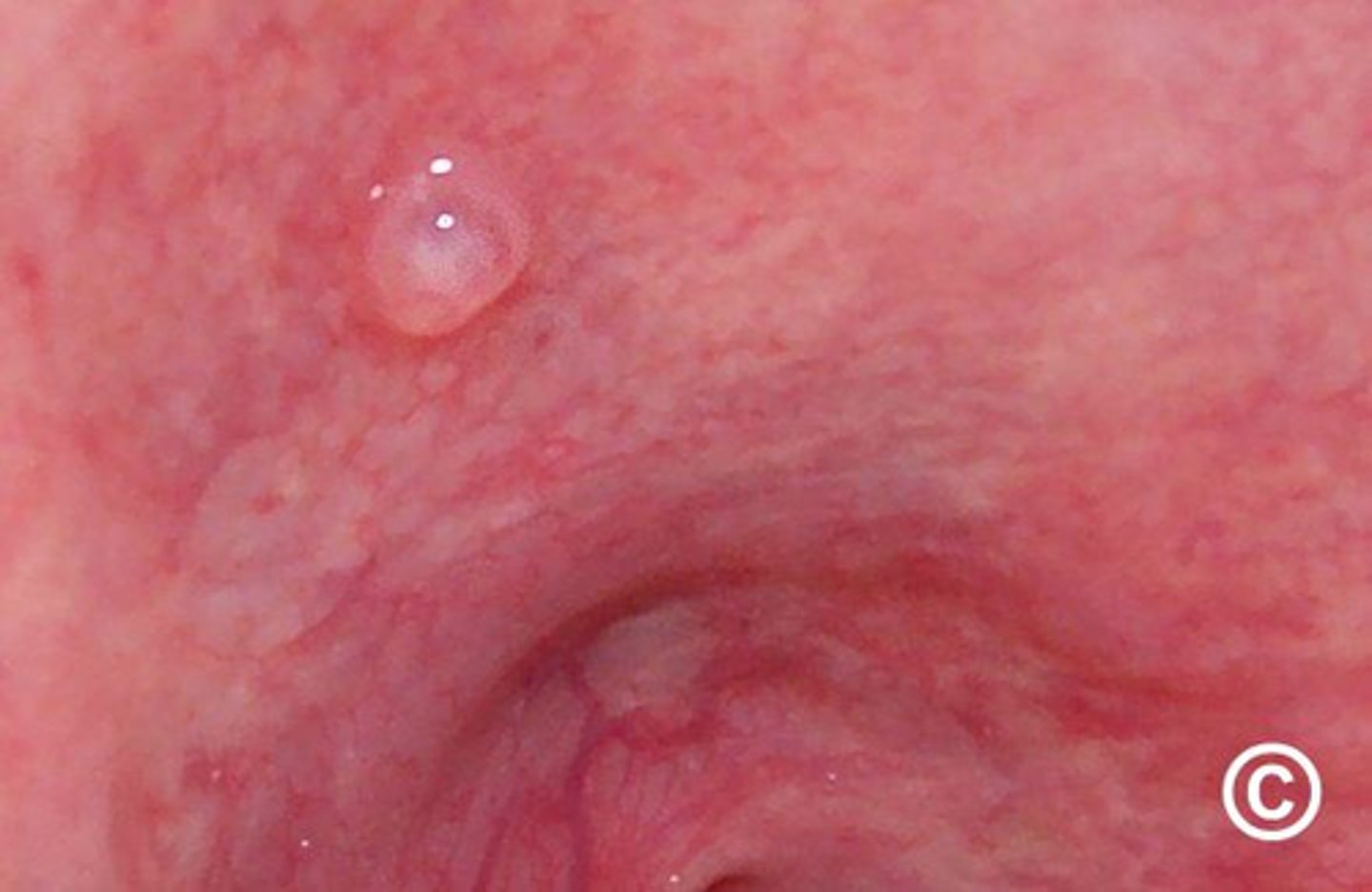 <p>fluid-filled sac on the soft palate</p>