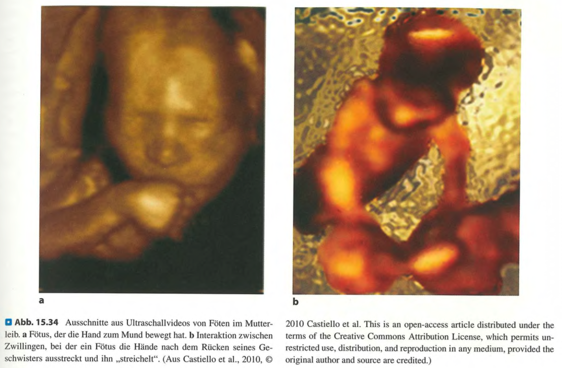 <p class=""><span data-name="brain" data-type="emoji">🧠</span><strong> Kurzfassung:</strong><br><strong>Soziale Berührung ist essenziell für die Entwicklung von Säuglingen</strong> – sie fördert <strong>Bindung</strong>, <strong>beruhigt</strong>, <strong>lindert Schmerz</strong> und unterstützt die <strong>soziale, kognitive und kommunikative Entwicklung</strong>. Hautkontakt aktiviert CT-Afferenzen und Insula-Areale, schon im Säuglingsalter.</p><div data-type="horizontalRule"><hr></div><p class=""><span data-name="clipboard" data-type="emoji">📋</span><strong> Langfassung:</strong></p><ul><li><p class=""><strong>Frühe Entwicklung:</strong></p><ul><li><p class=""><strong>Tastsinn</strong> ist der erste entwickelte Sinn (ab 8. SSW).</p></li><li><p class="">Ab <strong>26. SSW</strong> zeigen Föten aktive Berührungsreaktionen (z. B. eigenes Gesicht oder Zwilling berühren).</p></li></ul></li></ul><p class=""></p><ul><li><p class=""><strong>Eltern-Kind-Interaktion:</strong></p><ul><li><p class=""><strong>65 %</strong> der frühen Interaktionen beinhalten Berührung.</p></li><li><p class=""><strong>CT-Afferenzen</strong> werden bei langsamen, sanften Berührungen aktiviert → verbunden mit <strong>Wohlbefinden</strong>.</p></li></ul></li></ul><p class=""></p><ul><li><p class=""><strong>Beruhigende Wirkung:</strong></p><ul><li><p class=""><strong>Langsames Streicheln (ca. 3 cm/s)</strong> senkt die <strong>Herzfrequenz</strong> von Säuglingen.</p></li><li><p class="">Aktivierung des <strong>posterioren Insulakortex</strong> – wie bei erwachsener sozialer Berührung.</p></li></ul></li></ul><p class=""></p><ul><li><p class=""><strong>Schmerzlinderung:</strong></p><ul><li><p class=""><strong>Haut-zu-Haut-Kontakt</strong> („Kangaroo Care“) reduziert <strong>Weinen nach Schmerz</strong> um bis zu <strong>82 %</strong>.</p></li><li><p class="">Zeigt frühe <strong>Gate-Control-Mechanismen</strong> durch Berührung.</p></li></ul></li></ul><p class=""></p><ul><li><p class=""><strong>Langfristige Vorteile:</strong></p><ul><li><p class=""><strong>Mangel an Berührung</strong> (z. B. im Inkubator) kann <strong>negative Folgen</strong> haben.</p></li><li><p class=""><strong>Massageprogramme</strong> fördern <strong>Gewicht</strong>, <strong>Schlaf</strong> und <strong>Kognition</strong>.</p></li></ul></li></ul><p class=""></p><ul><li><p class=""><strong>Fazit:</strong></p><ul><li><p class=""><strong>Soziale Berührung + kindzentrierte Sprache</strong> sind gemeinsam <strong>mächtige Mittel</strong> zur Entwicklungsförderung.</p></li><li><p class="">Besonders wichtig für <strong>Frühgeborene</strong> und in der <strong>frühen Bindungsphase</strong>.</p></li></ul></li></ul><p></p>