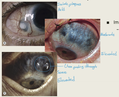 <p> Necrotizing scleritis without inflammation; typically affects elderly women with rheumatoid arthritis.</p>