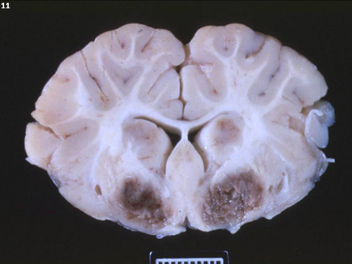 <p>11.<span>&nbsp; </span>Tissue from a sheep.<span>&nbsp;&nbsp; </span>Which of the following is NOT true concerning this condition?</p><ol type="a"><li><p>All ages of sheep can be affected except newborns.</p></li><li><p>The causative agent produces epsilon toxin and iota toxin.</p></li><li><p>The marked hyperglycemia and hyperglycosuria resulting from infection causes a pulpy aspect to the kidneys.</p></li><li><p>While all ruminants are susceptible to this disease, only sheep suffer from the neurologic disease.</p></li></ol><p></p>