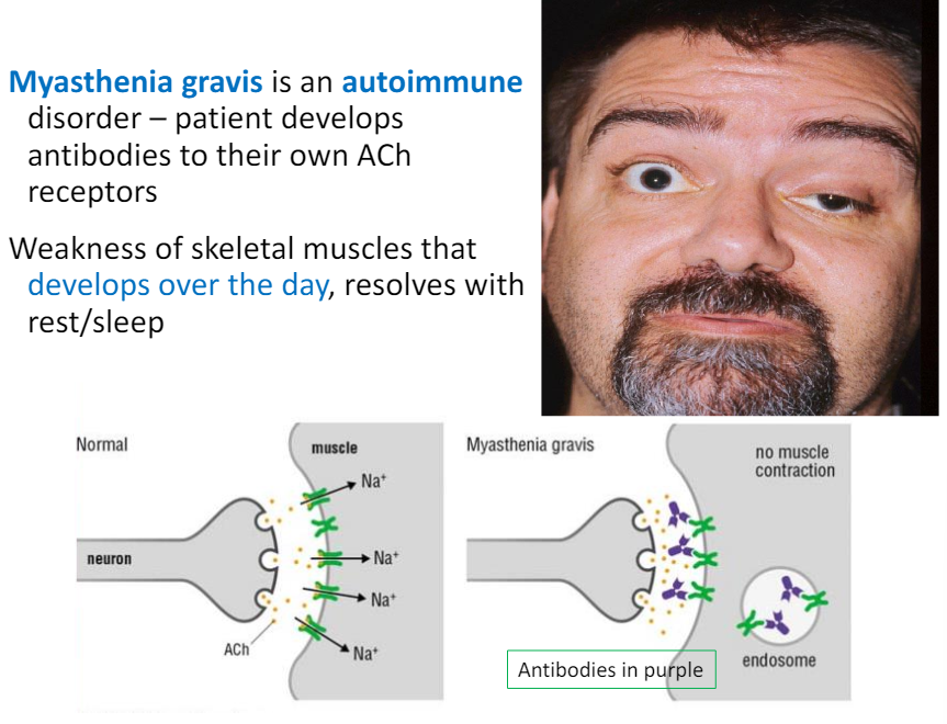 <p>autoimmune disorder - patients develop antibodies to their own ACh receptors</p><p>symptoms: weakness of skeletal muscles that develops over the day, but resolves with rest/sleep </p>