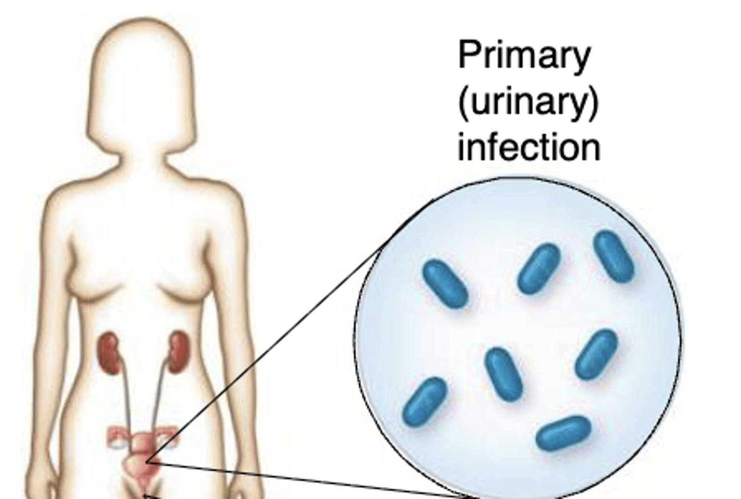 <p>initial infection</p>