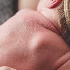 <p>Lanugo (Hair)</p>