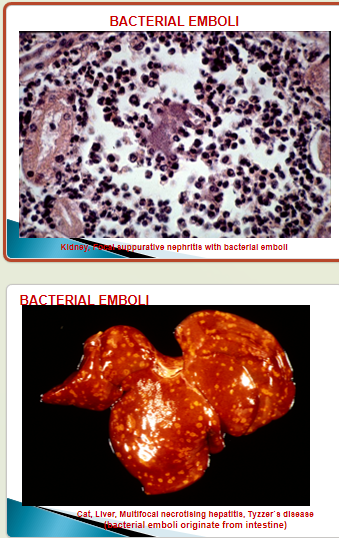 <p><em>E.g. bacterial endocarditis</em> —&gt; bacterial embolus in pulmonary &amp; systemic circulation </p>