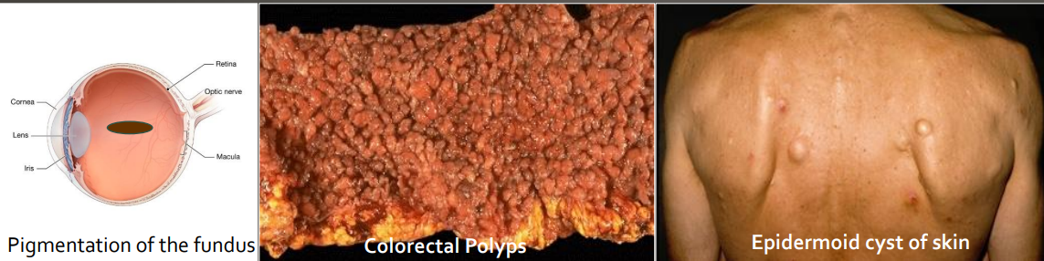 <ul><li><p>colorectal polyps (can become malignant) </p></li><li><p>multiple osteoma (bone tumor in head) </p></li><li><p>epidermoid cysts of skin </p></li><li><p>supernumerary teeth </p></li><li><p>thyroid carcinoma </p></li><li><p>pigmented ocular fundus (90%)</p></li></ul><p></p>