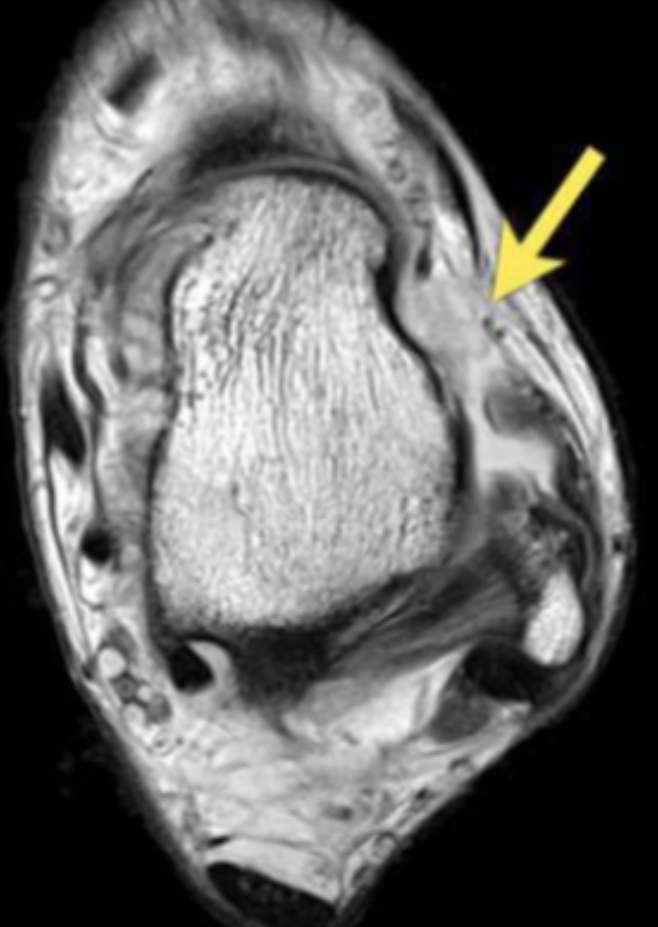 <p>Describe the pathology indicated by the arrow (Ax PD). </p>