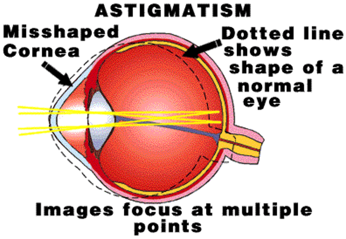 <p>a defect in the eye or in a lens caused by a deviation from spherical curvature, which results in distorted images, as light rays are prevented from meeting at a common focus</p>