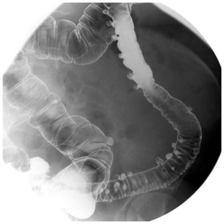 <p>What pathology is shown here?</p>