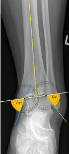 <p>Q what is the right angle of this radiograph? and what is the average + range?</p>