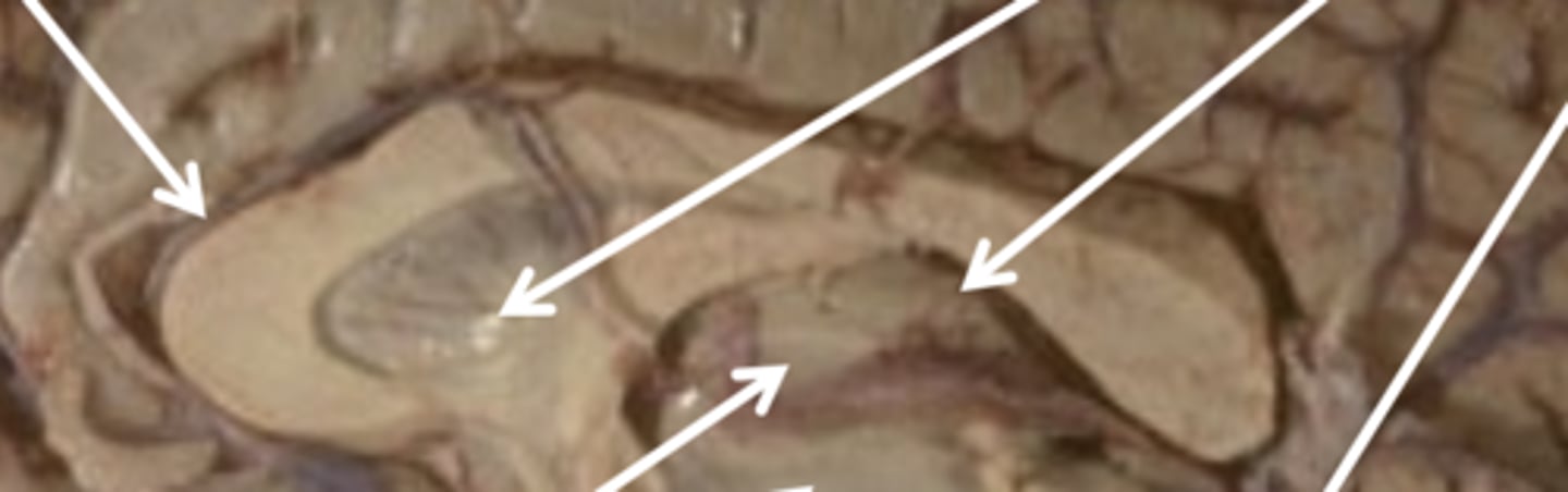 <p>major white-matter tract connecting hemispheres</p>