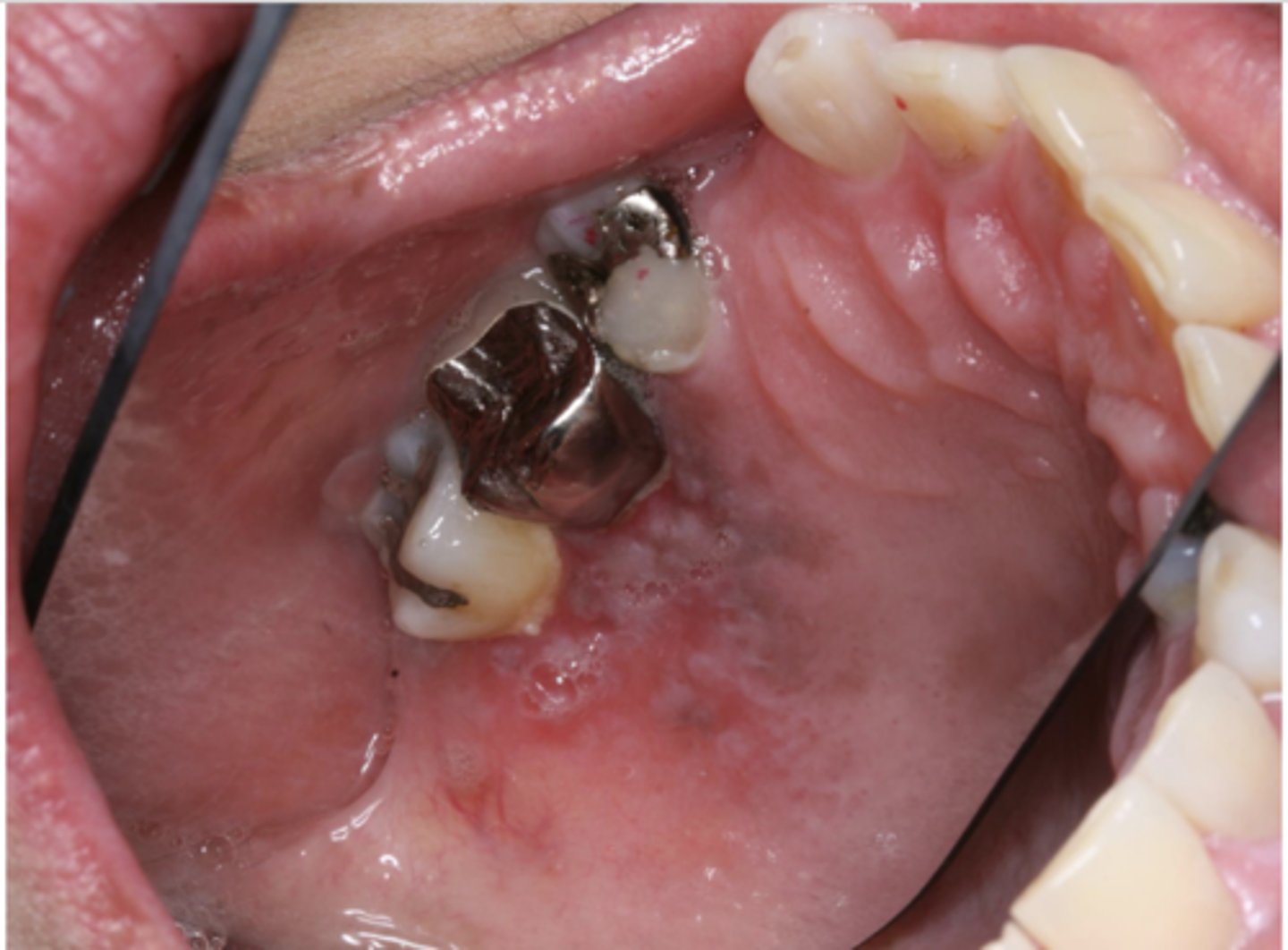<p>What type of pigmented lesion?</p>