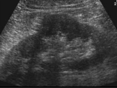 <p>What anatomic variant is this and which kidney is it most commonly found in:</p>