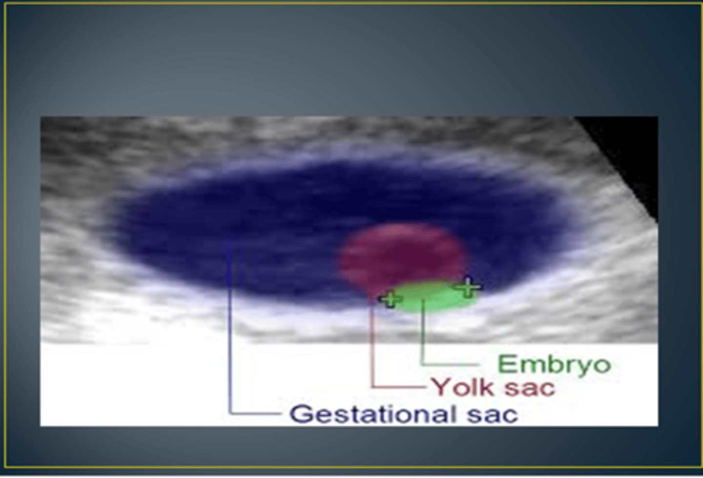 <p>yolk sac is inside of the gestational sac</p>