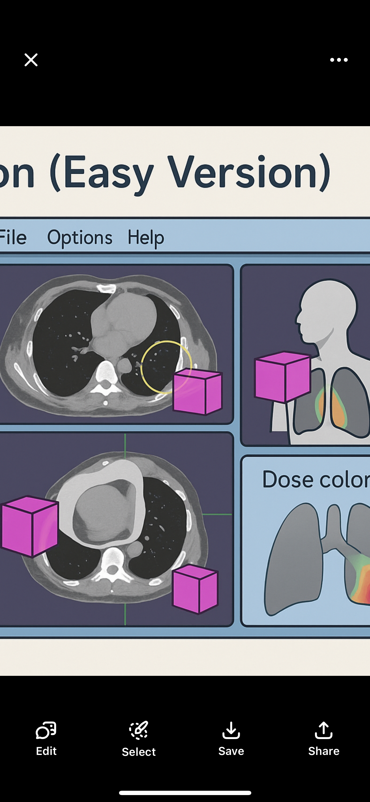 <ul><li><p><span>A CT scan of the patient is taken.</span></p><ol><li><p><span>The scan is loaded into special software.</span></p></li><li><p><span>The team uses the software to:<br></span></p><ul><li><p><span>Outline (contour) the tumor and organs.</span></p></li><li><p><span>Place the radiation beams in the best directions.</span></p></li><li><p><span>Add blocks/shields to protect healthy areas.</span></p></li><li><p><span>Plan where the skin marks (tattoos or stickers) go.</span></p></li></ul></li></ol></li></ul><p></p>