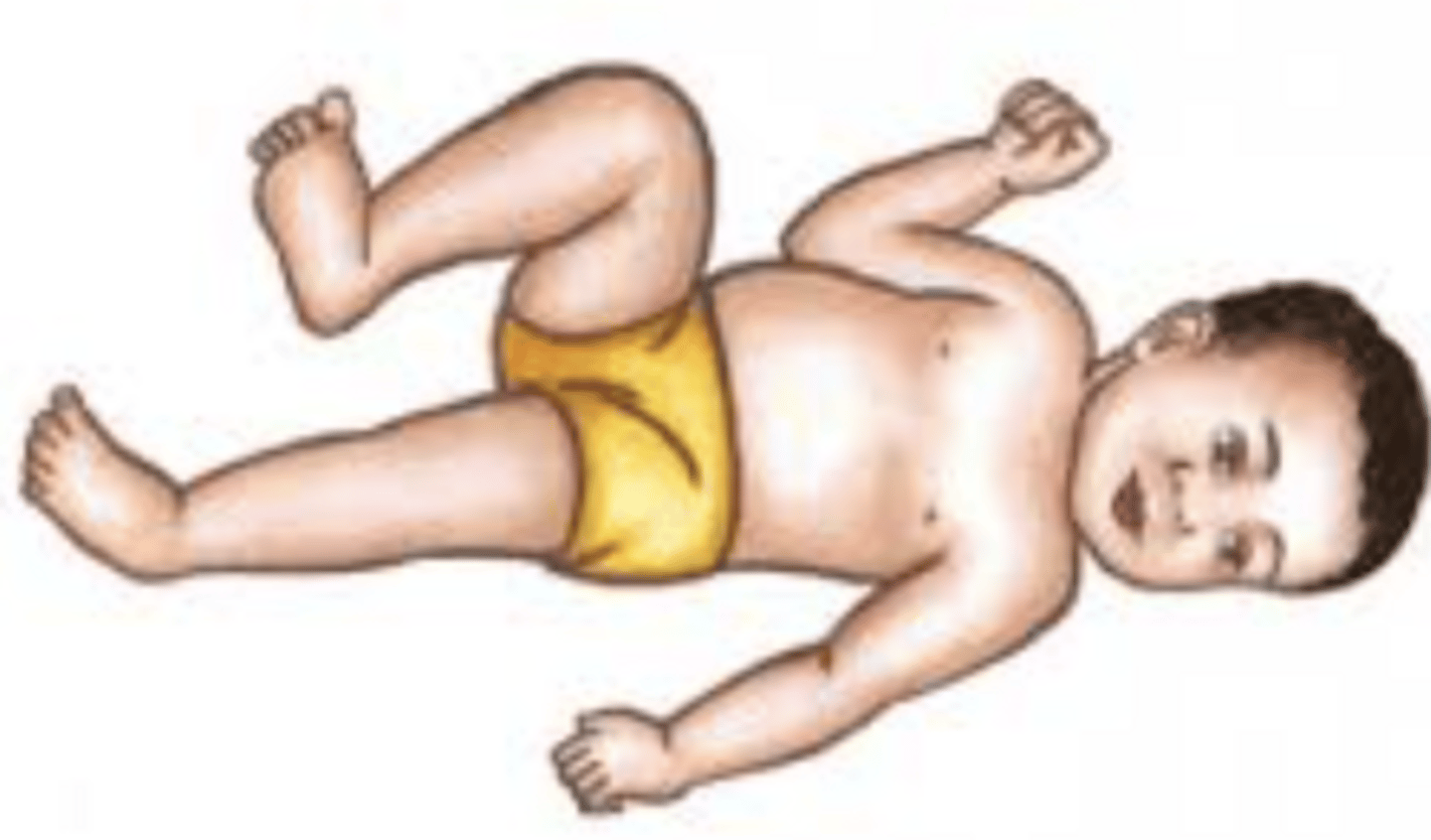 <p>Extension (and ABD) of the arm and leg on the side the child is looking at with flexion (and ABD) of the arm and leg on opposite side (i.e., when the infant looks to the L, the L UE + LE extends)</p>