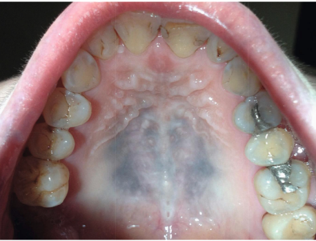 <ol><li><p><strong>diffuse</strong>, painless, <strong>symmetric </strong>bluish-gray <strong>macule</strong></p></li><li><p>melanonychia + skin lesions</p></li></ol><p></p>