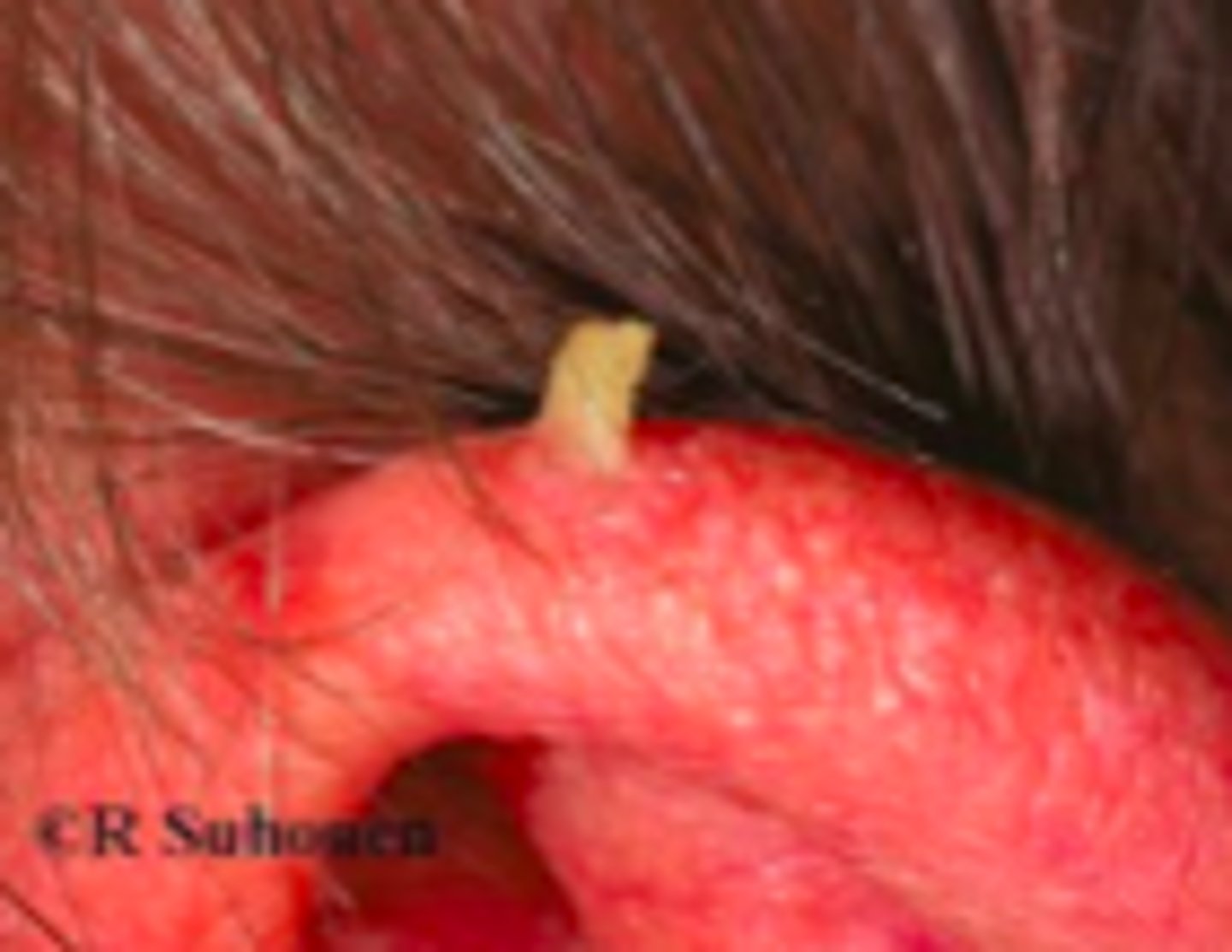 <p>Keratotic Disorders:</p><p>Subjective:</p><p>- More common in older patients, with peak incidence in those between 60-70</p><p>- More common in people with fairer skin</p><p>- Usually asymptomatic, but can be injured to cause pain/inflammation</p>