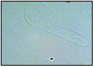 Most frequently seen cast; parallel sides and rounded ends, cylindroid form, wrinkled of convoluted form (aging)
