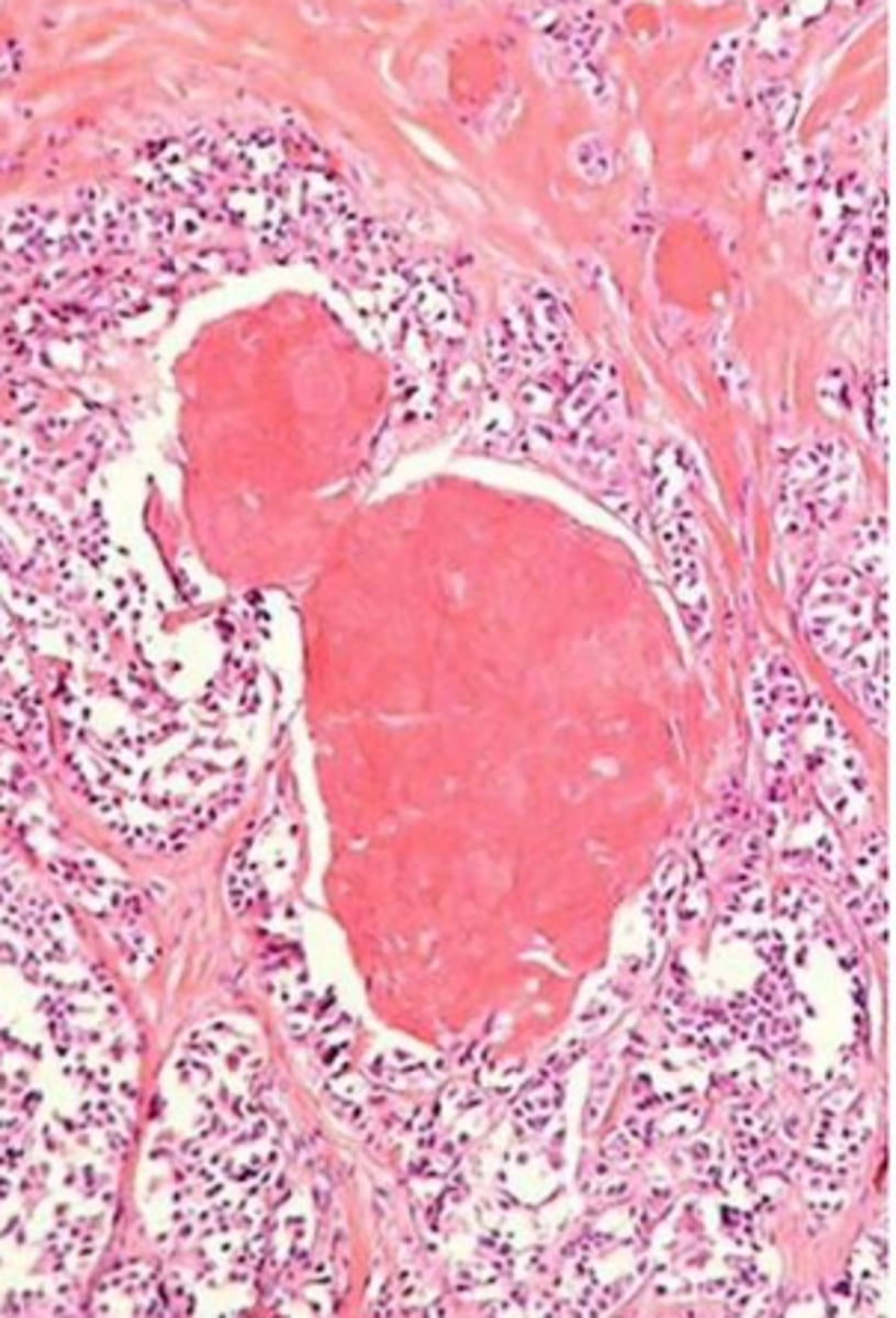 <p>amyloid stains positively with calcitonin immunostains</p>