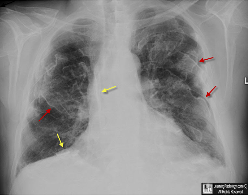 <p>What does this CXR reading indicate </p><ul><li><p>Pleural plaques (MC lower lobes)</p></li><li><p>“Honeycomb lung” – irregular linear opacities</p></li><li><p>“Shaggy heart sign”</p><ul><li><p>Indistinct heart borders</p></li><li><p>Ground glass appearance of lung fields</p></li></ul></li></ul><p></p>