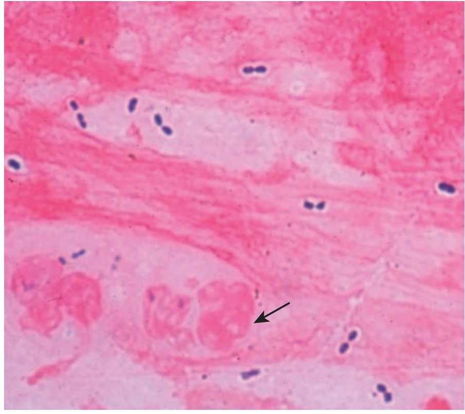 <p>Lancet shaped diplococci</p>