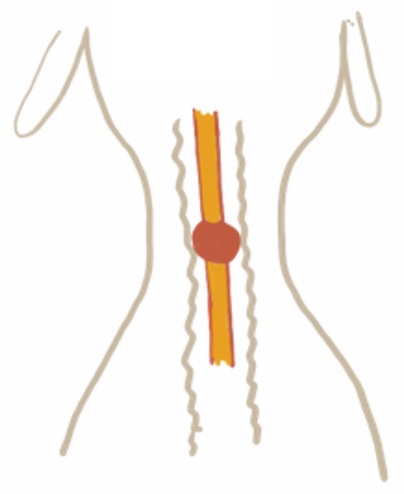 <p>ET tubes with low volume, high pressure cuffs. The cuffs are more rounded creating a small area of high pressure on the tracheal tissue</p>