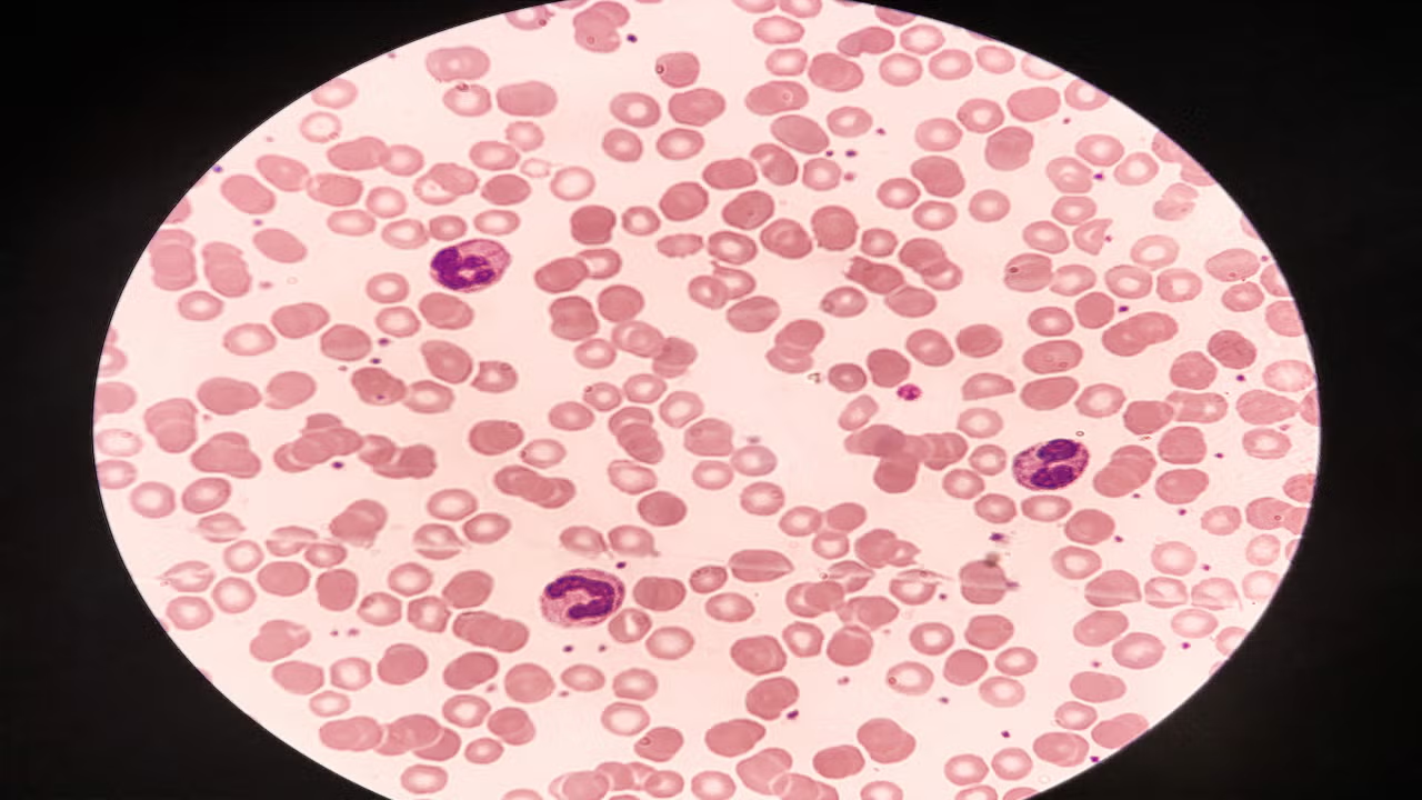 <ul><li><p>RBCs coated w/ IgG and/or complement</p><ul><li><p>Macrophages phagocytize these</p></li></ul></li></ul><ul><li><p>Lab: Spherocytes, MCHC &gt;37 g/dL, increased osmotic fragility, bilirubin, reticulocyte count, occasional nRBCs (DAT).</p></li></ul><p></p>