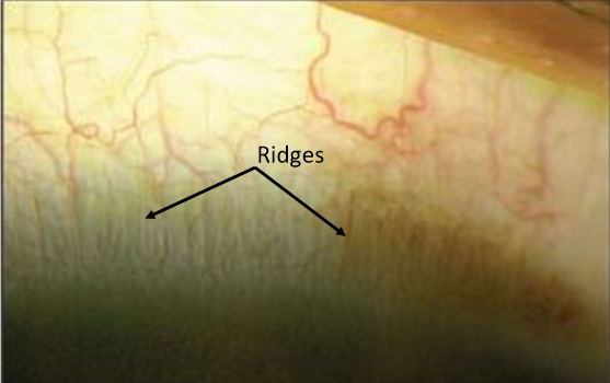 <ul><li><p>conj epithelium transitions into corneal epithelium</p></li><li><p>8-10 layers thick</p></li><li><p>stem cells for bulbar conj epithelium and conreal epithelium reside</p></li><li><p>radial folds increase surface area for basal cell proliferation</p></li></ul><p></p>