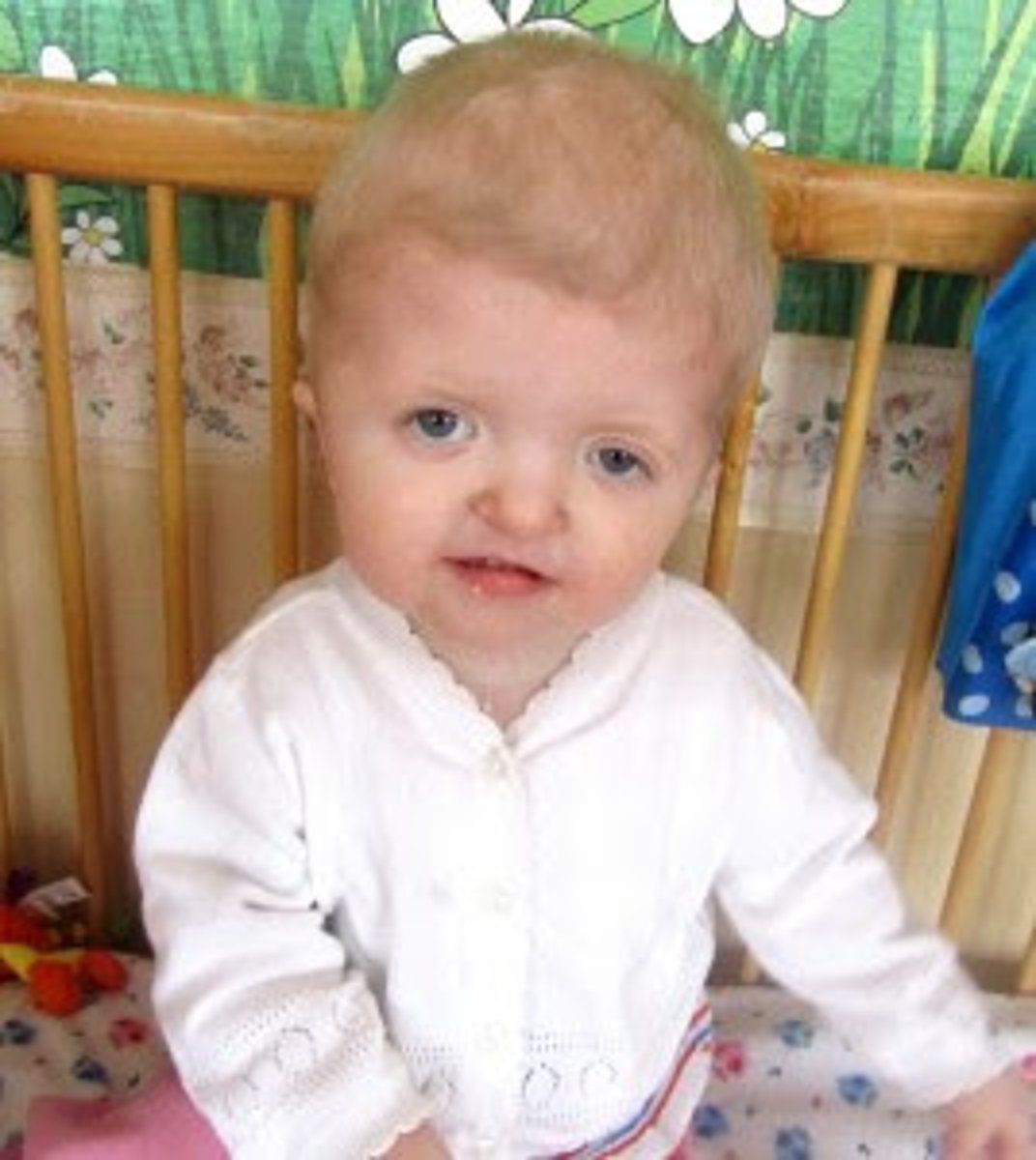 <p>syndactyly, craniosynostosis, midfacial hypoplasia, cleft 25-30% of time</p><p>conductive hearing loss sometimes, hyponasality, artic (s,z,f,v)</p><p>normal intelligence sometimes, sometimes mild to moderate intellectual disability</p>