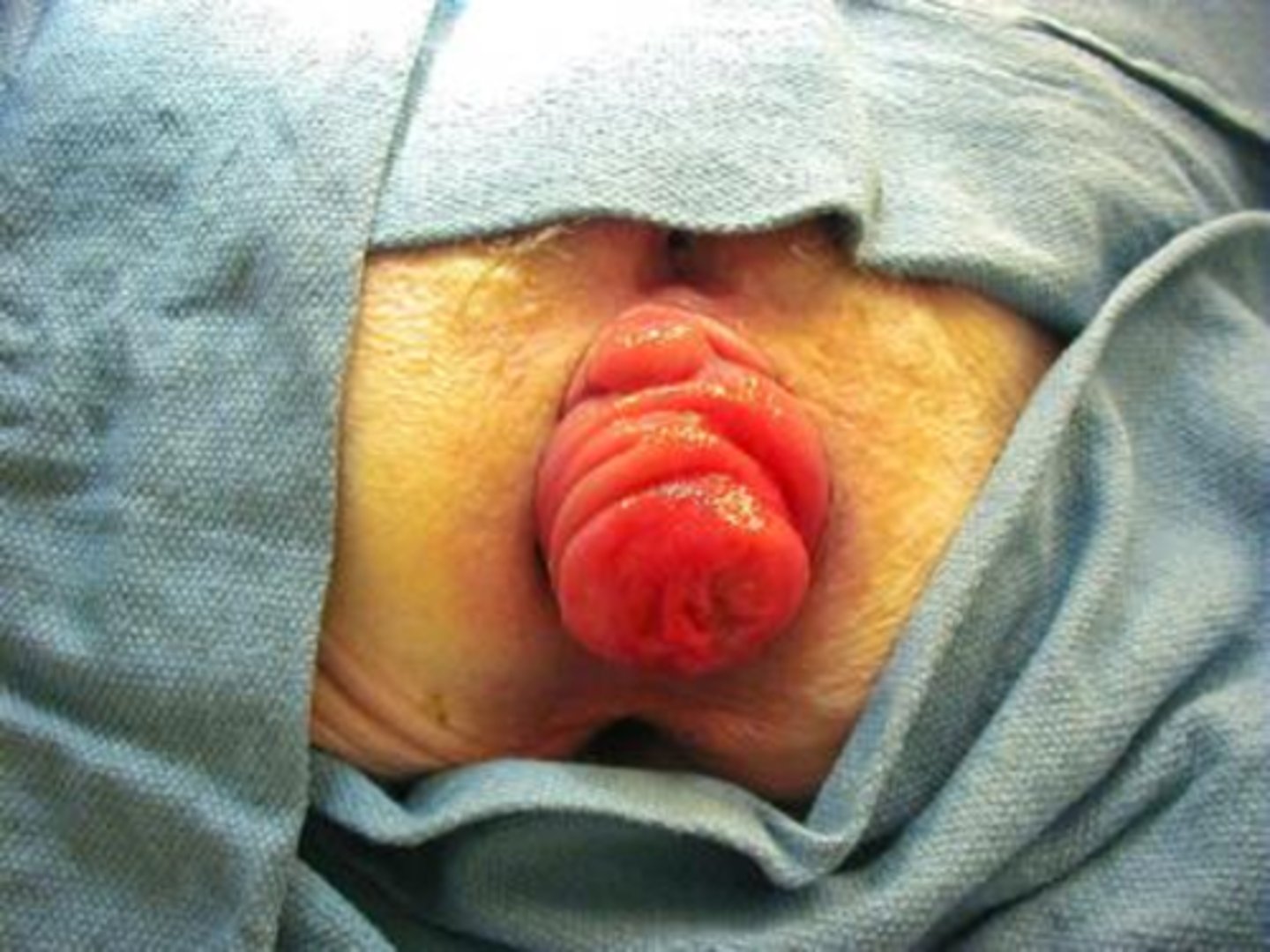 <p>rectal prolapse</p>