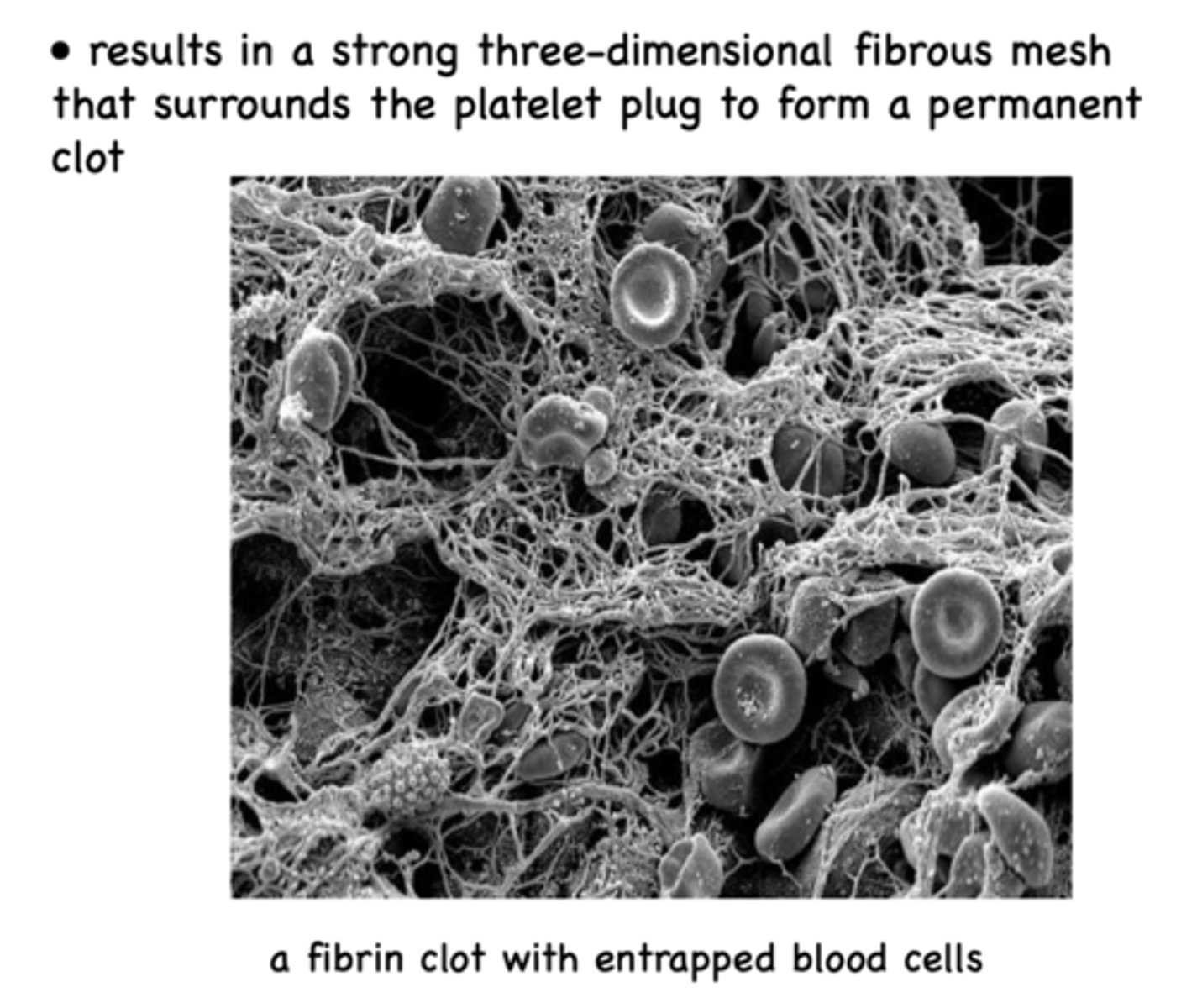 <p>permanent clot</p>